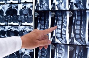 spinal surgery auckland