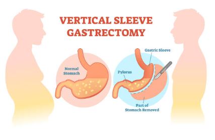 gastric sleeve