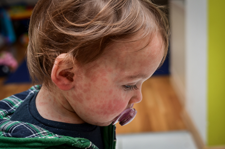 Close up of a toddler with measles, indicating the importance of vigilance during a measles outbreak